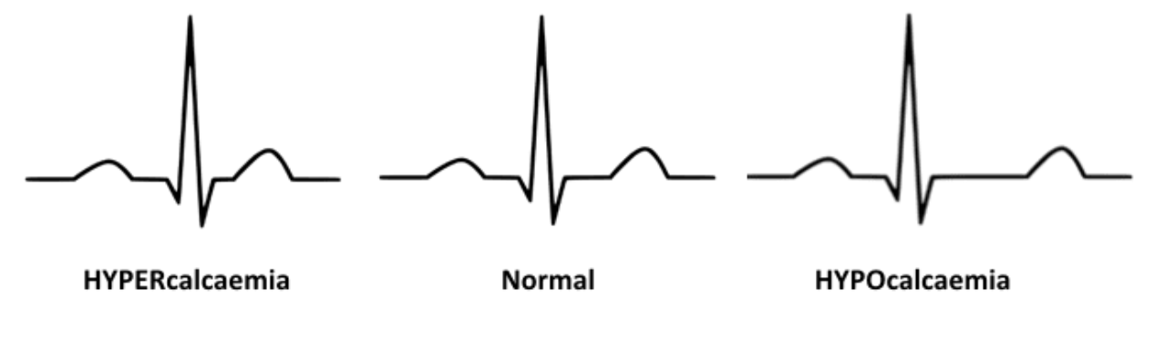 Shortening of QT interval 